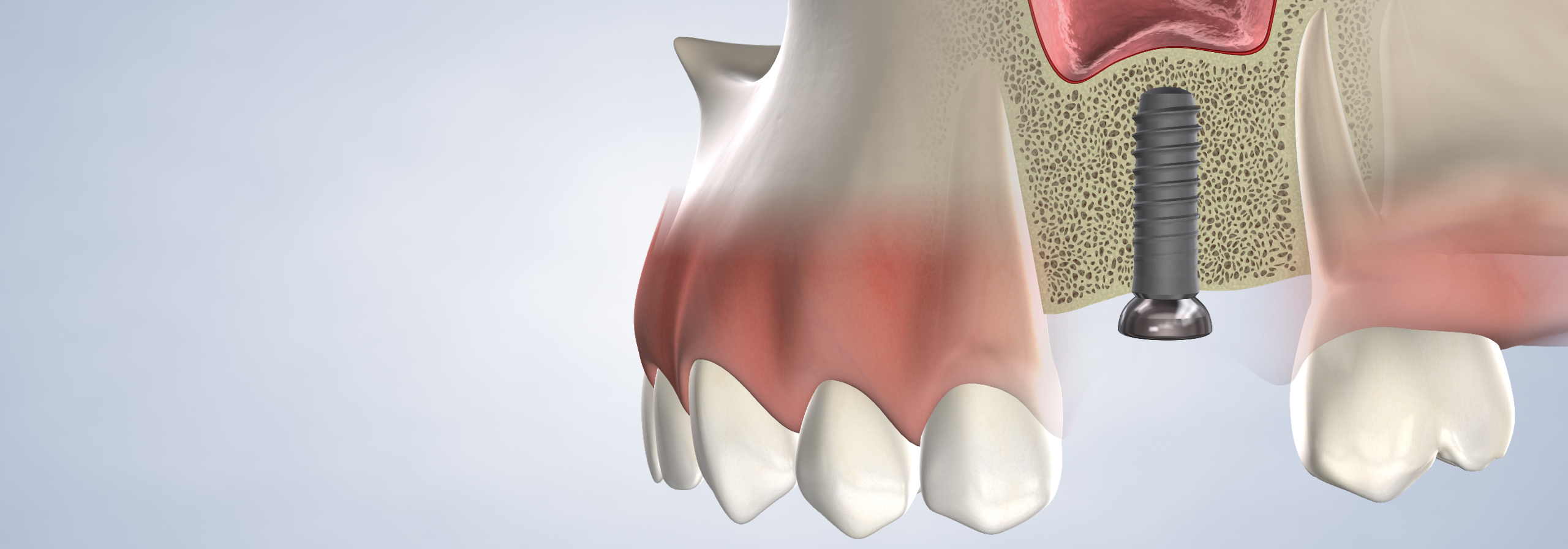 Bone grafting in Louisville and Mt. Washington, KY, and Jeffersonville, IN