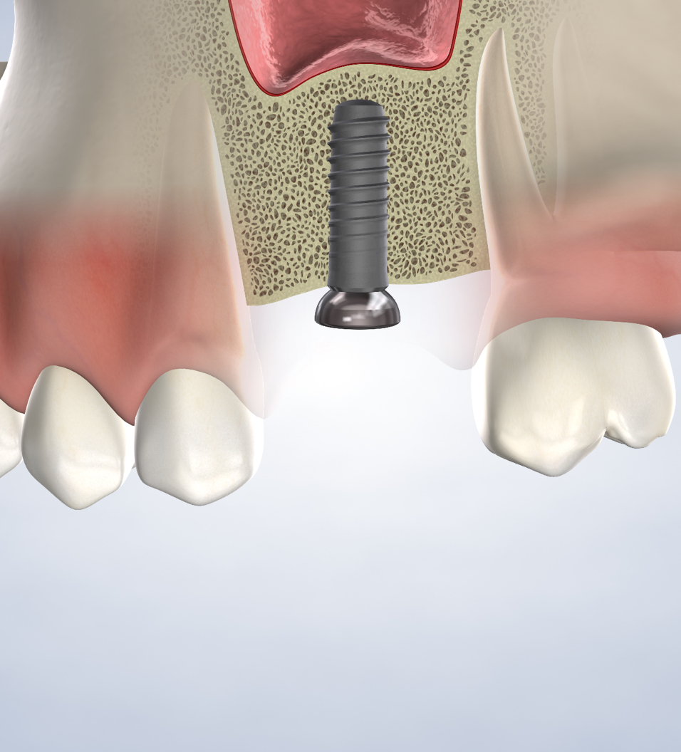 Bone grafting in Louisville and Mt. Washington, KY, and Jeffersonville, IN