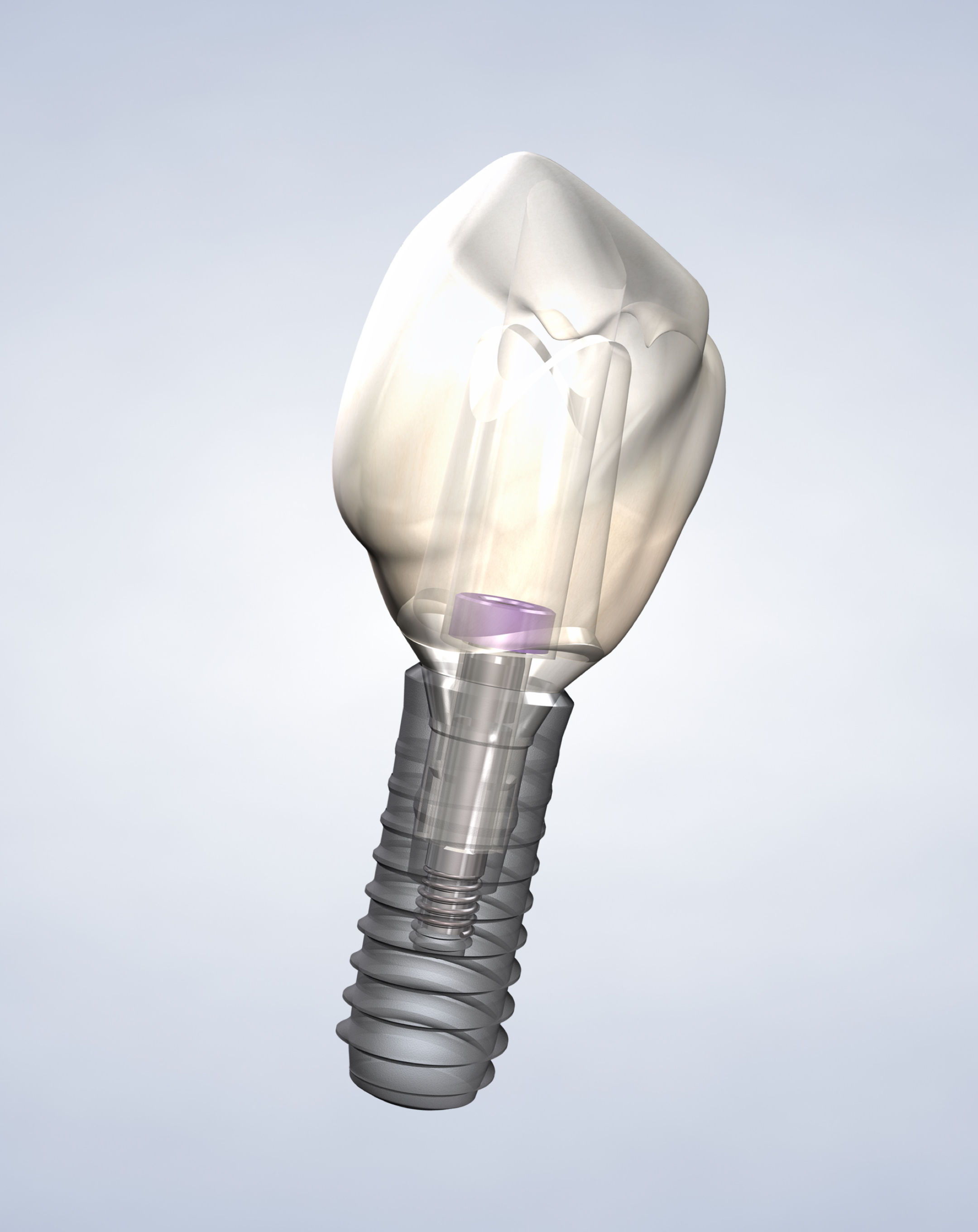 Dental implants in Louisville and Mt. Washington, KY, and Jeffersonville, IN