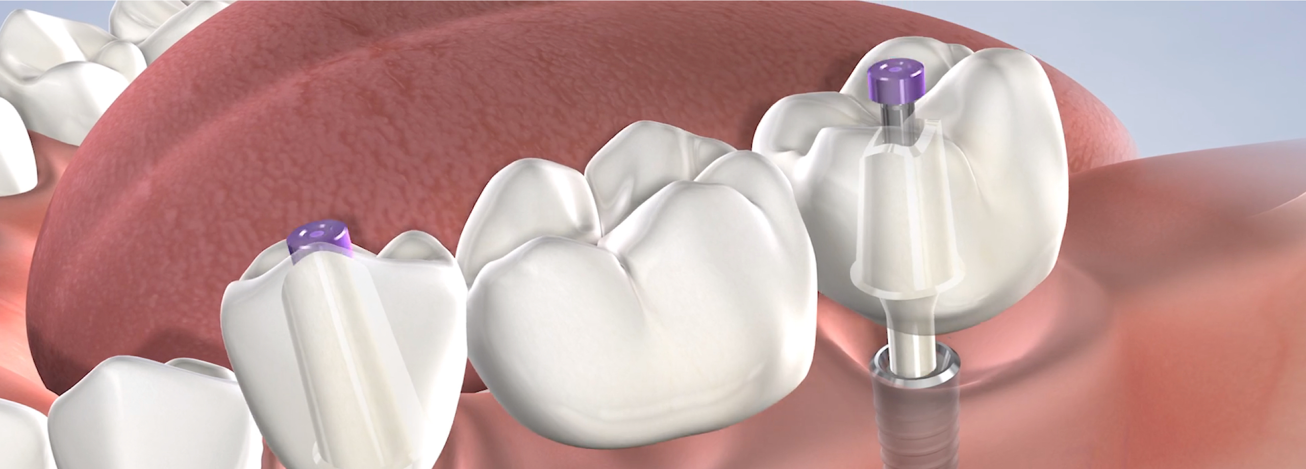KOMS/DEV/procedure dental-implant-benefits-video