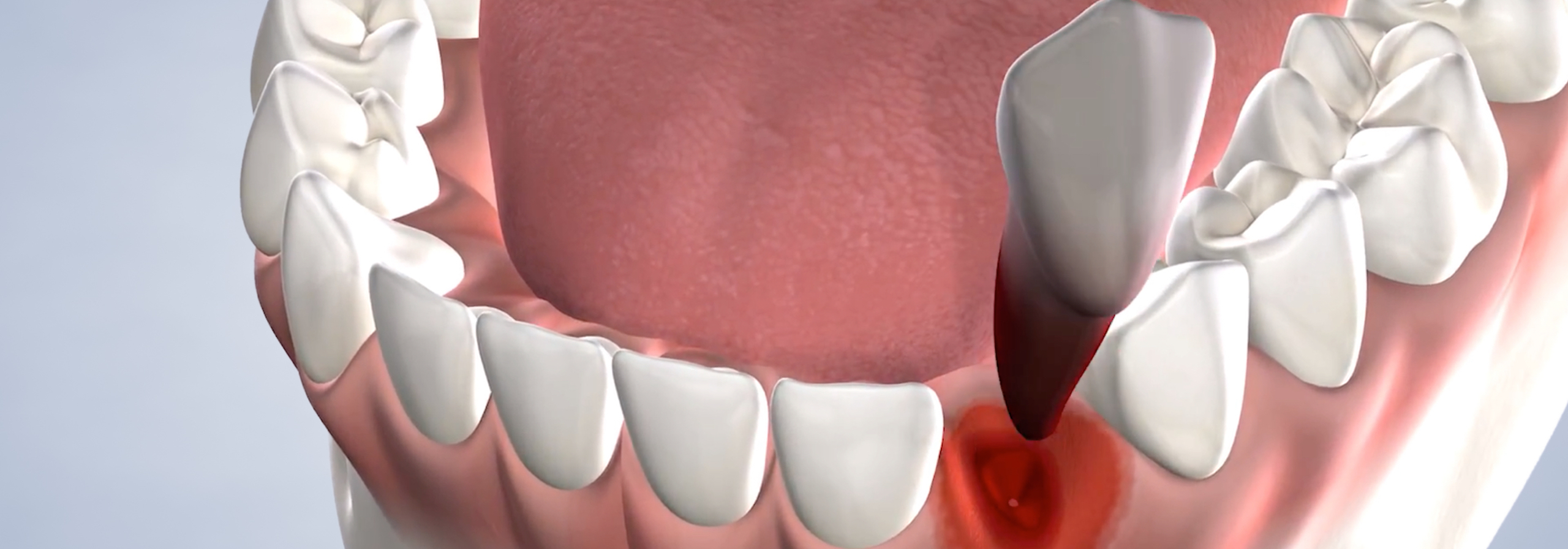 Tooth extraction in Louisville and Mt. Washington, KY, and Jeffersonville, IN