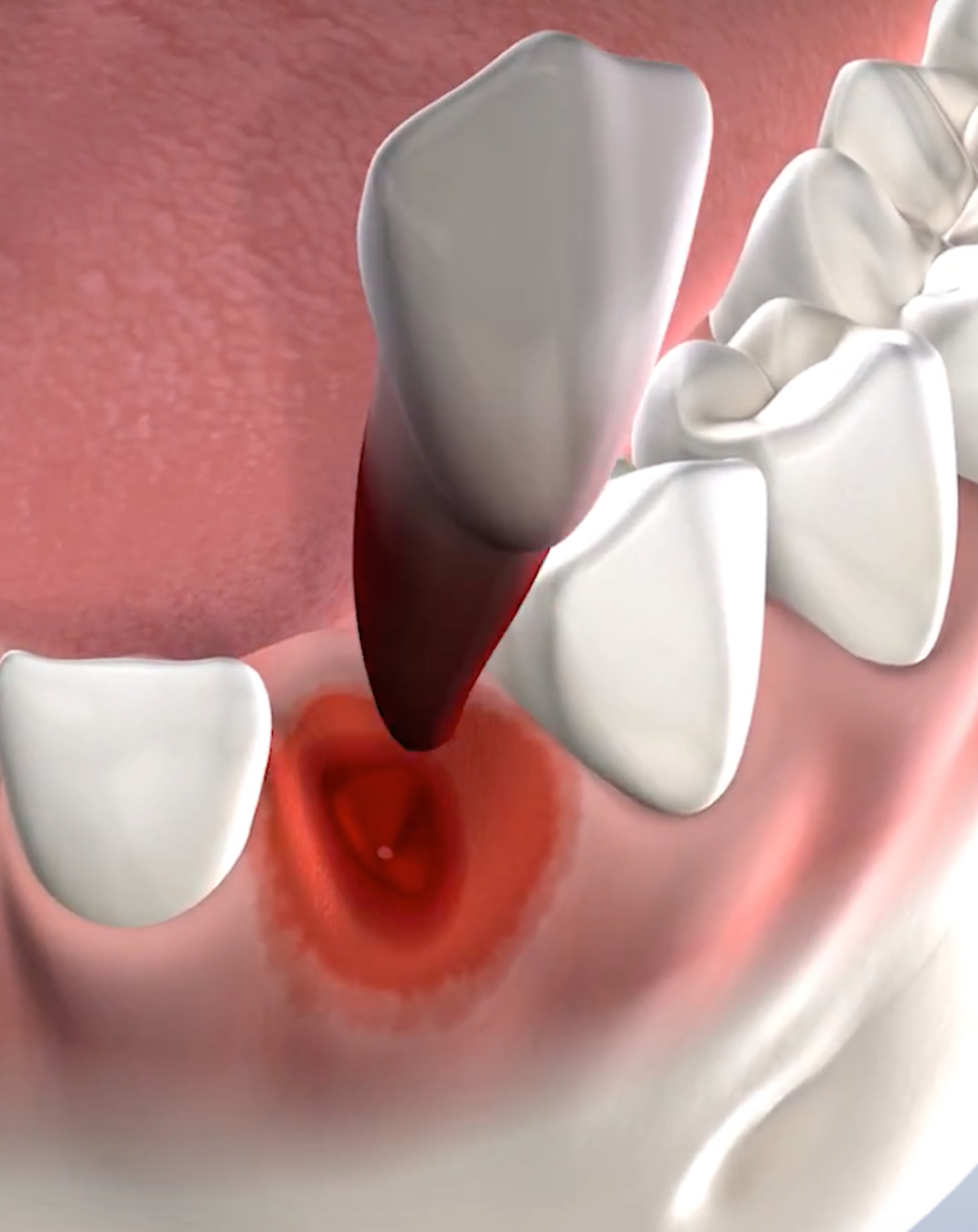 Tooth extractions in Louisville and Mt. Washington, KY, and Jeffersonville, IN