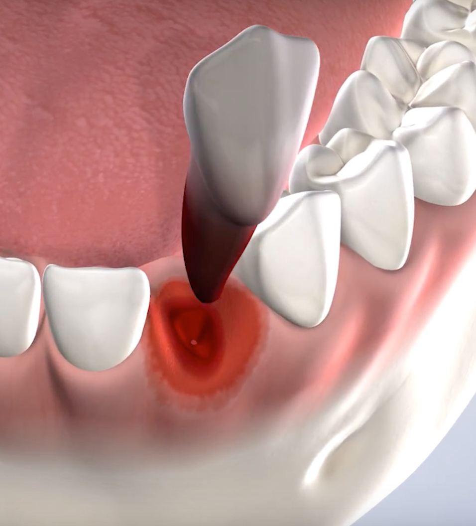 Tooth extraction in Louisville and Mt. Washington, KY, and Jeffersonville, IN