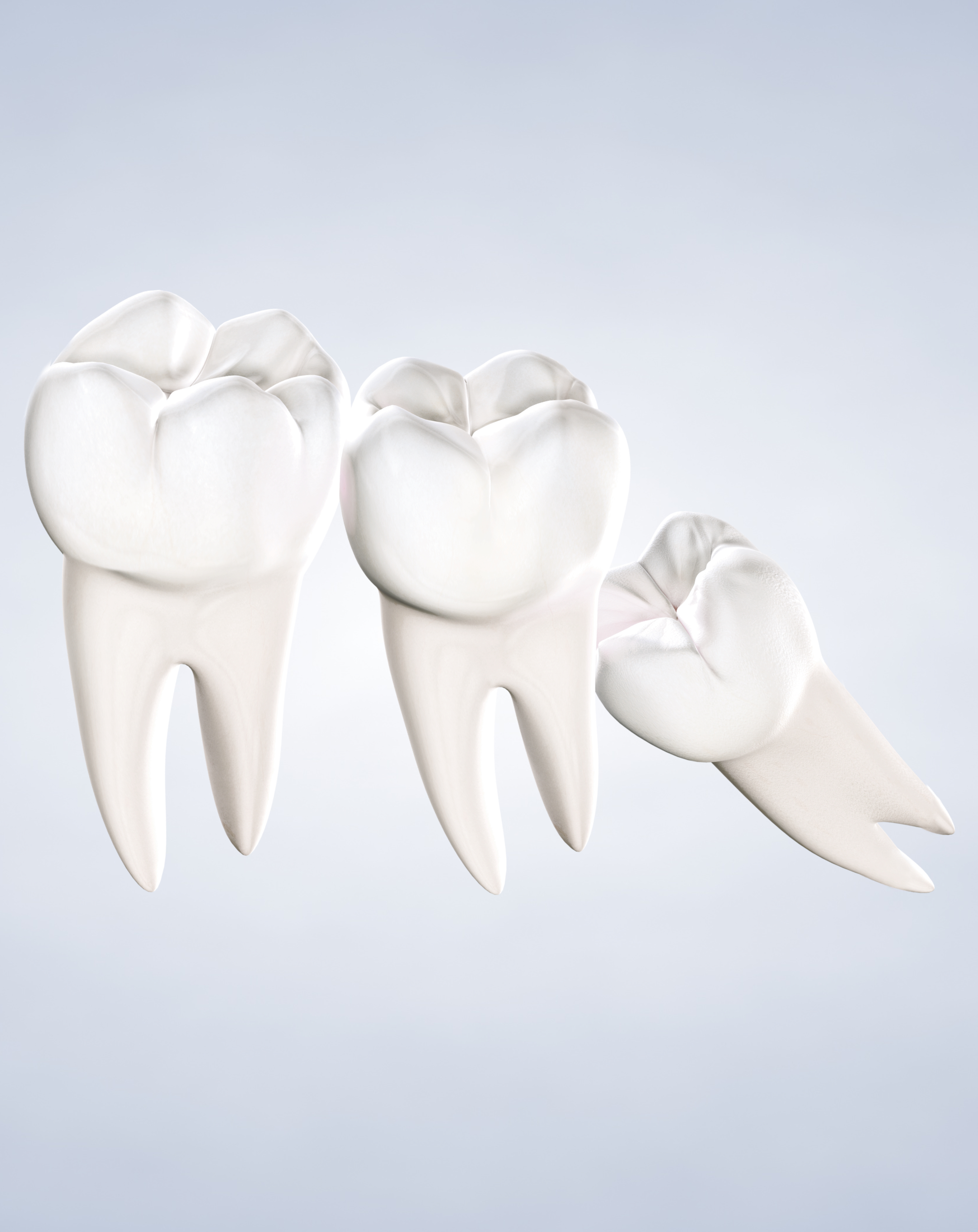 Wisdom teeth removal in Louisville and Mt. Washington, KY, and Jeffersonville, IN