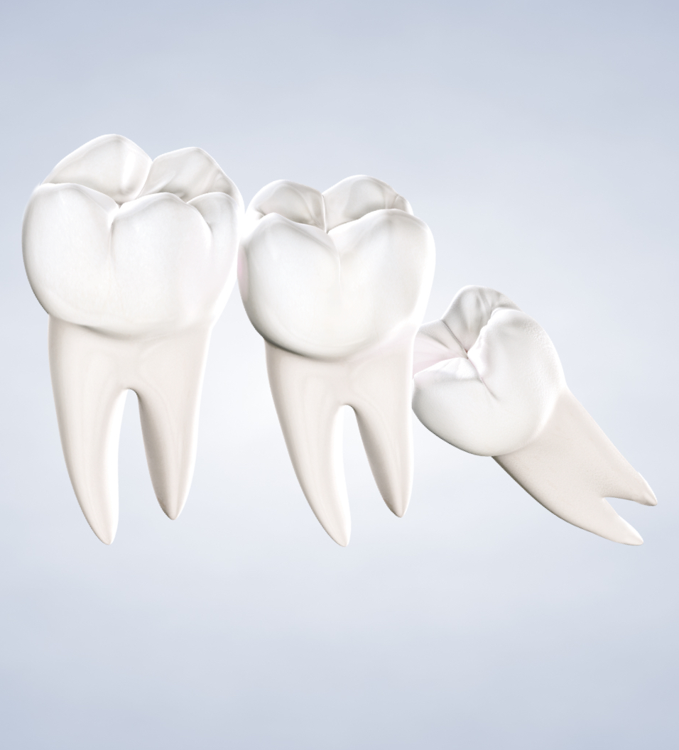 Wisdom teeth removal in Louisville and Mt. Washington, KY, and Jeffersonville, IN